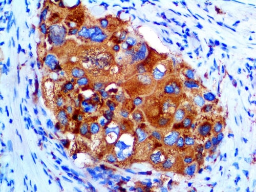 IHC of Napsin on an FFPE Lung Adenocarcinoma Tissue